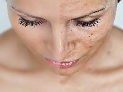 Peeling facial químico, ¿qué es y para qué sirve?